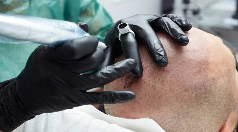 prix en dinars tatouage médical cheveux ou barbe Tunisie