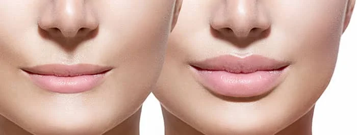 augmentation lèvres tunisie pas cher