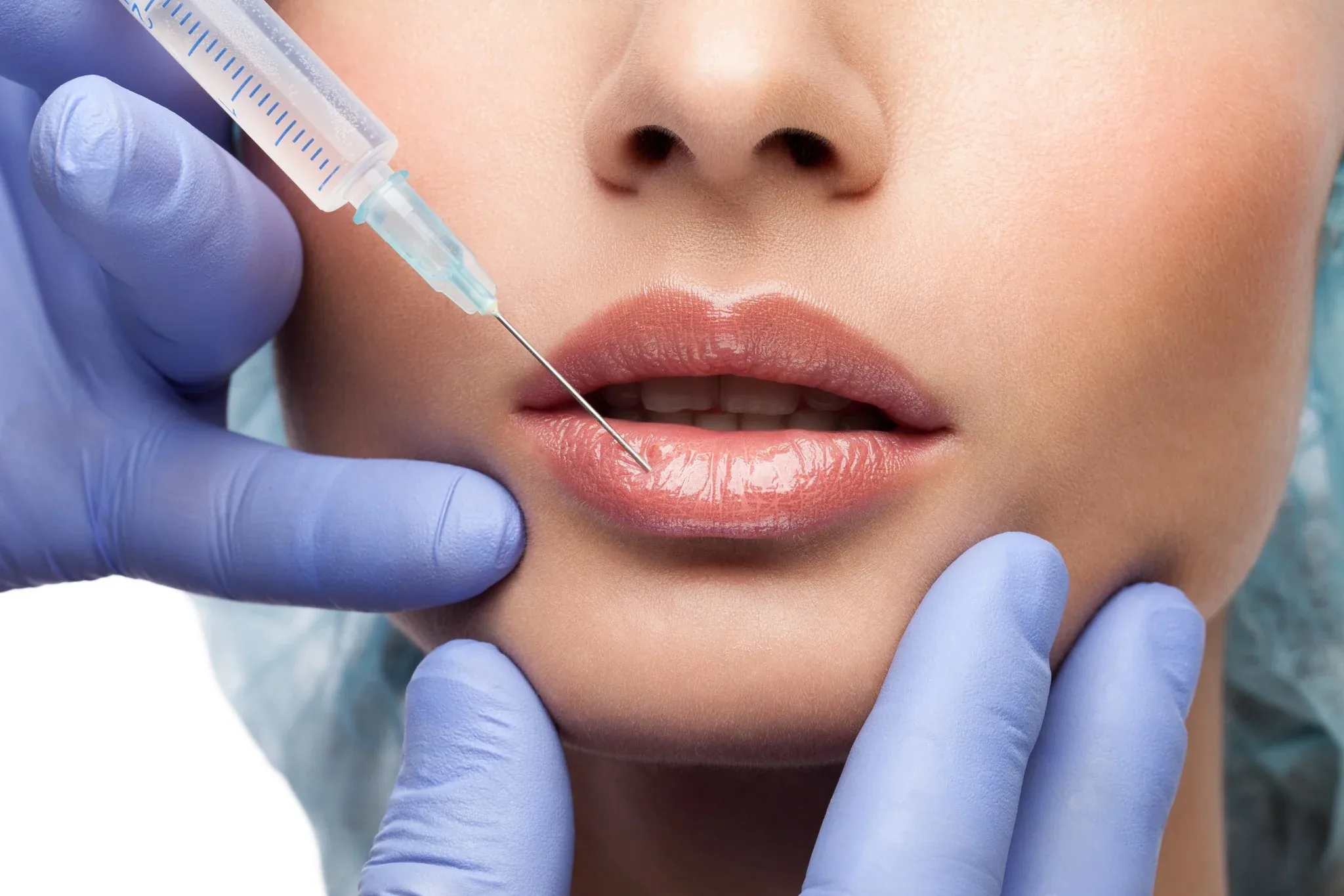 Injections esthétiques : corriger sans effacer son visage