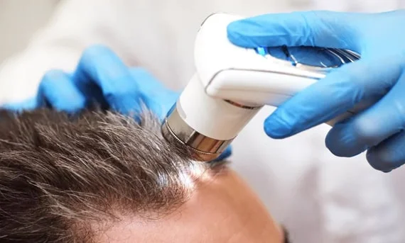 traitement médecine esthétique pour la chute des cheveux