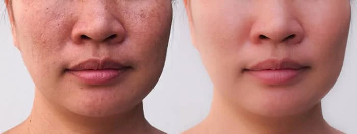 traitement taches brunes du visage avant et aorès